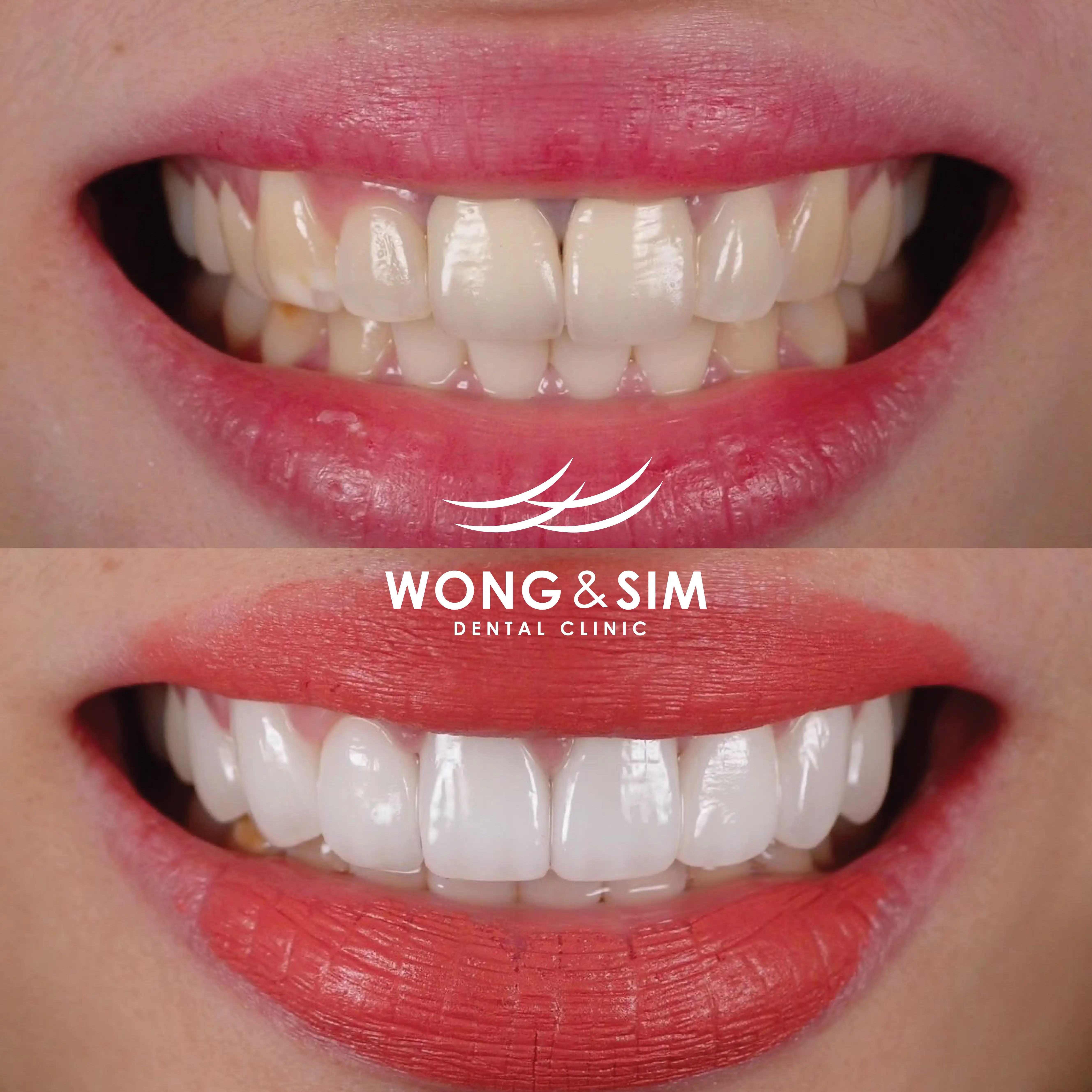 Patient 9 - Smile Makeover Before and After